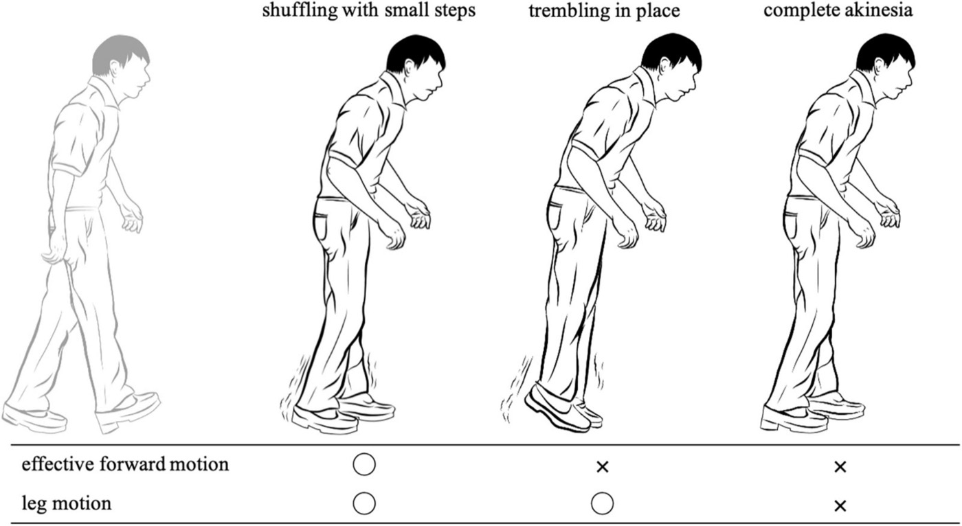Diagram of shuffling, trembling in place, and complete akinesia in freezing of gait